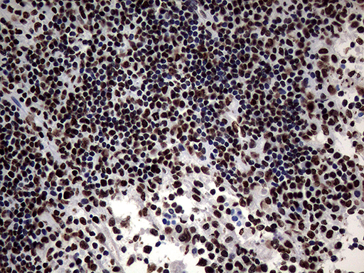 Immunohistochemical staining of paraffin-embedded Carcinoma of Human lung tissue using anti-SH3BGRL mouse monoclonal antibody