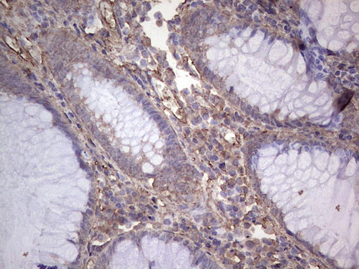 Immunohistochemical staining of paraffin-embedded Adenocarcinoma of Human colon tissue using anti-NUDT12 mouse monoclonal antibody