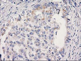 Immunohistochemical staining of paraffin-embedded Carcinoma of Human lung tissue using anti-MRPS2 mouse monoclonal antibody