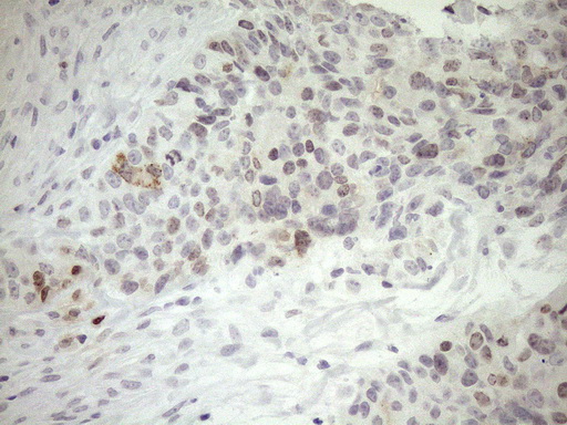 Immunohistochemical staining of paraffin-embedded Adenocarcinoma of Human endometrium tissue using anti-ZNF230 mouse monoclonal antibody