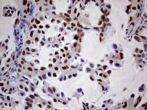 Immunohistochemical staining of paraffin-embedded Carcinoma of Human lung tissue using anti-N4BP2L2 mouse monoclonal antibody