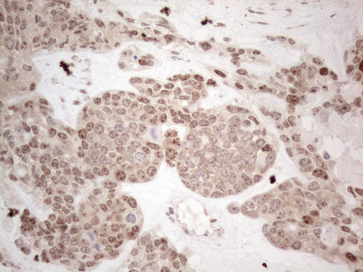 Immunohistochemical staining of paraffin-embedded Adenocarcinoma of Human endometrium tissue using anti-HMGB4 mouse monoclonal antibody