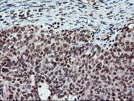 Immunohistochemical staining of paraffin-embedded Adenocarcinoma of Human ovary tissue using anti-TPSG1 mouse monoclonal antibody