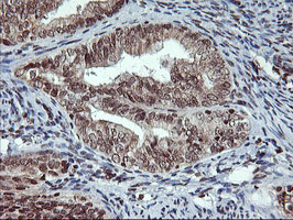 Immunohistochemical staining of paraffin-embedded Adenocarcinoma of Human endometrium tissue using anti-TPSG1 mouse monoclonal antibody