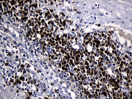 Immunohistochemical staining of paraffin-embedded Carcinoma of Human bladder tissue using anti-ZFP37 mouse monoclonal antibody. (Heat-induced epitope retrieval by 1mM EDTA in 10mM Tris buffer (pH8.5) at 120°C for 3min