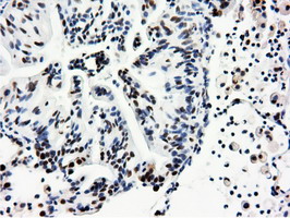 Immunohistochemical staining of paraffin-embedded Carcinoma of Human lung tissue using anti-NT5DC1 mouse monoclonal antibody