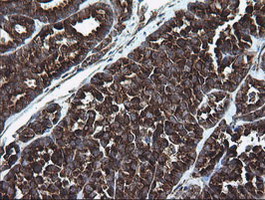 Immunohistochemical staining of paraffin-embedded Carcinoma of Human thyroid tissue using anti-ARMC1 mouse monoclonal antibody. (Heat-induced epitope retrieval by 10mM citric buffer
