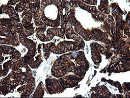 Immunohistochemical staining of paraffin-embedded Adenocarcinoma of Human endometrium tissue using anti-ARMC1 mouse monoclonal antibody. (Heat-induced epitope retrieval by 10mM citric buffer
