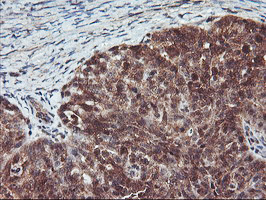 Immunohistochemical staining of paraffin-embedded Adenocarcinoma of Human ovary tissue using anti-RABL2A mouse monoclonal antibody