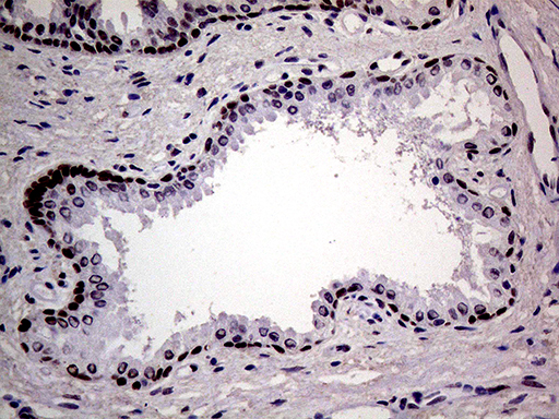 Immunohistochemical staining of paraffin-embedded Carcinoma of Human prostate tissue using anti-MAGEB4 mouse monoclonal antibody