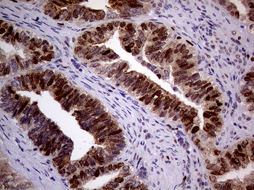 Immunohistochemical staining of paraffin-embedded Adenocarcinoma of Human endometrium tissue using anti-MAGEB4 mouse monoclonal antibody
