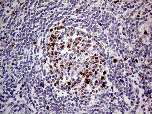 Immunohistochemical staining of paraffin-embedded Human lymph node tissue within the normal limits using anti-MAGEB4 mouse monoclonal antibody