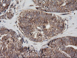 Immunohistochemical staining of paraffin-embedded Adenocarcinoma of Human ovary tissue using anti-MRPS34 mouse monoclonal antibody