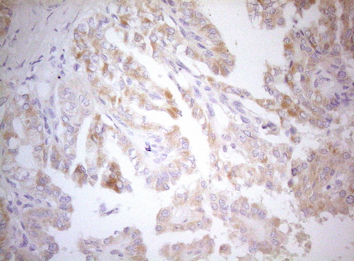 Immunohistochemical staining of paraffin-embedded Carcinoma of Human thyroid tissue using anti-MXD4 mouse monoclonal antibody