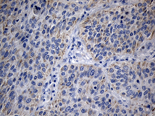 Immunohistochemical staining of paraffin-embedded Carcinoma of Human lung tissue using anti-MRPL48 mouse monoclonal antibody