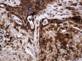 Immunohistochemical staining of paraffin-embedded Carcinoma of Human lung tissue using anti-POGK mouse monoclonal antibody