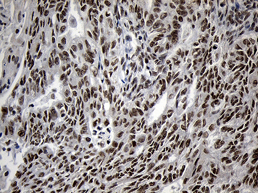 Immunohistochemical staining of paraffin-embedded Adenocarcinoma of Human endometrium tissue using anti-ZNF670 mouse monoclonal antibody. (Heat-induced epitope retrieval by 1mM EDTA in 10mM Tris buffer (pH8.5) at 120°C for 3min