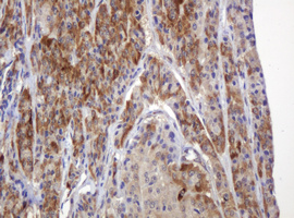 Immunohistochemical staining of paraffin-embedded Carcinoma of Human thyroid tissue using anti-TBC1D13 mouse monoclonal antibody. (Heat-induced epitope retrieval by 10mM citric buffer