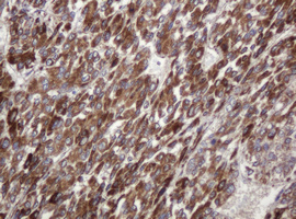 Immunohistochemical staining of paraffin-embedded Carcinoma of Human liver tissue using anti-TBC1D13 mouse monoclonal antibody. (Heat-induced epitope retrieval by 10mM citric buffer
