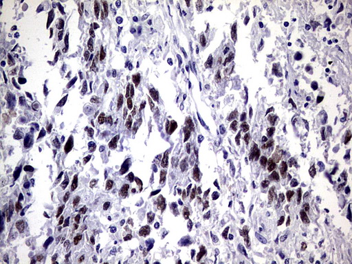 Immunohistochemical staining of paraffin-embedded Adenocarcinoma of Human ovary tissue using anti-ZNF34 mouse monoclonal antibody. (Heat-induced epitope retrieval by 1 mM EDTA in 10mM Tris