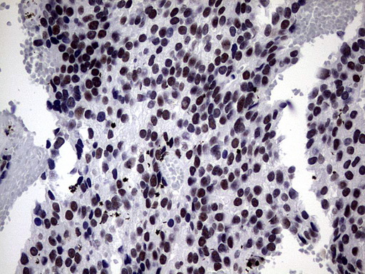 Immunohistochemical staining of paraffin-embedded Adenocarcinoma of Human breast tissue using anti-ZNF34 mouse monoclonal antibody. (Heat-induced epitope retrieval by 1 mM EDTA in 10mM Tris