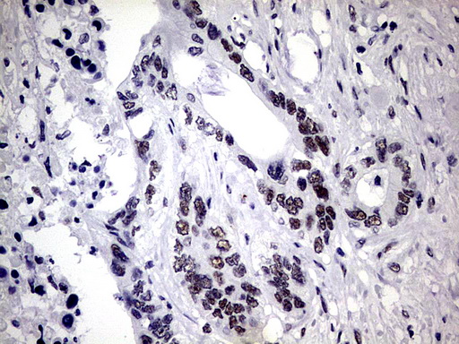 Immunohistochemical staining of paraffin-embedded Adenocarcinoma of Human colon tissue using anti-ZNF34 mouse monoclonal antibody. (Heat-induced epitope retrieval by 1 mM EDTA in 10mM Tris