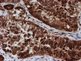 Immunohistochemical staining of paraffin-embedded Adenocarcinoma of Human ovary tissue using anti-CRYZL1 mouse monoclonal antibody
