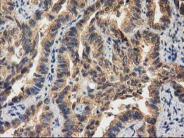 Immunohistochemical staining of paraffin-embedded Carcinoma of Human lung tissue using anti-CHCHD5 mouse monoclonal antibody