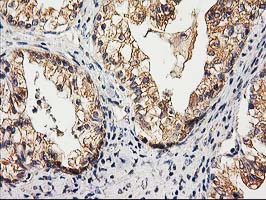 Immunohistochemical staining of paraffin-embedded Adenocarcinoma of Human ovary tissue using anti-CHCHD5 mouse monoclonal antibody