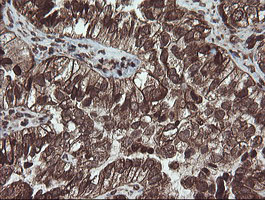 Immunohistochemical staining of paraffin-embedded Adenocarcinoma of Human ovary tissue using anti-CXorf26 mouse monoclonal antibody