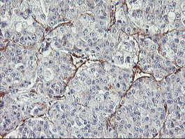 Immunohistochemical staining of paraffin-embedded Carcinoma of Human liver tissue using anti-MIER2 mouse monoclonal antibody. (Heat-induced epitope retrieval by 10mM citric buffer