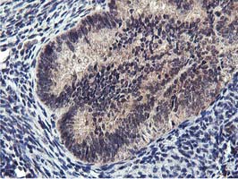 Immunohistochemical staining of paraffin-embedded Adenocarcinoma of Human endometrium tissue using anti-MIER2 mouse monoclonal antibody