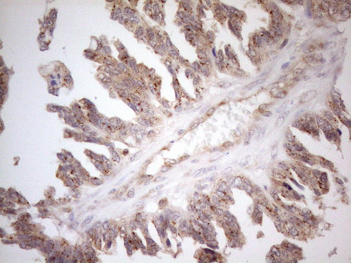 Immunohistochemical staining of paraffin-embedded Adenocarcinoma of Human ovary tissue using anti-ZNF69 mouse monoclonal antibody