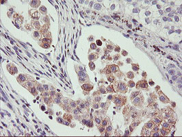 Immunohistochemical staining of paraffin-embedded Carcinoma of Human lung tissue using anti-PHF21B mouse monoclonal antibody