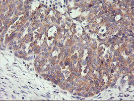 Immunohistochemical staining of paraffin-embedded Adenocarcinoma of Human ovary tissue using anti-PHF21B mouse monoclonal antibody