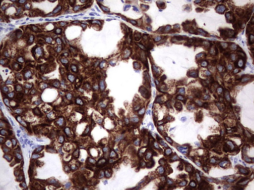 Immunohistochemical staining of paraffin-embedded Carcinoma of Human lung tissue using anti-ENKUR mouse monoclonal antibody