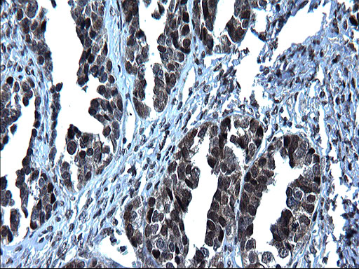Immunohistochemical staining of paraffin-embedded Adenocarcinoma of Human ovary tissue using anti-ZFAND3 mouse monoclonal antibody