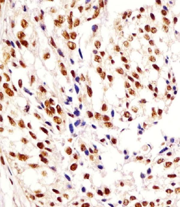 M16841 staining HNRNPA1L2 in human breast carcinoma tissue sections by Immunohistochemistry (IHC-P -paraformaldehyde-fixed, paraffin-embedded sections). Tissue was fixed with formaldehyde and blocked with 3% BSA for 0. 5 hour at room temperature; antigen retrieval was by heat mediation with a citrate buffer (pH6). Samples were incubated with primary antibody (1/25) for 1 hours at 37°C. A undiluted biotinylated goat polyvalent antibody was used as the secondary antibody.
