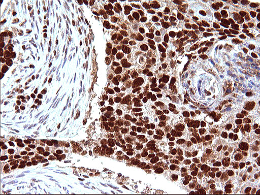 Immunohistochemical staining of paraffin-embedded Carcinoma of Human lung tissue using anti-POLR3GL mouse monoclonal antibody