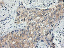 Immunohistochemical staining of paraffin-embedded Carcinoma of Human lung tissue using anti-ITFG2 mouse monoclonal antibody