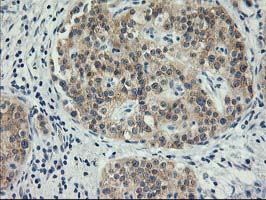Immunohistochemical staining of paraffin-embedded Carcinoma of Human pancreas tissue using anti-ITFG2 mouse monoclonal antibody