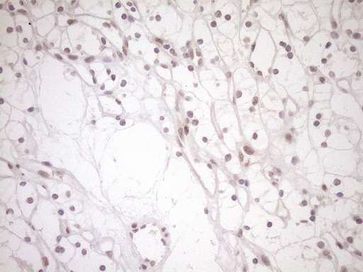 Immunohistochemical staining of paraffin-embedded Carcinoma of Human kidney tissue using anti-NAP1L3 mouse monoclonal antibody