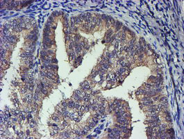 Immunohistochemical staining of paraffin-embedded Adenocarcinoma of Human endometrium tissue using anti-TCP11L2 mouse monoclonal antibody. (Heat-induced epitope retrieval by 10mM citric buffer Immunohistochemical staining of paraffin-embedded Adenocarcinoma of Human endometrium tissue using anti-TCP11L2 mouse monoclonal antibody. (Heat-induced epitope retrieval by 10mM citric buffer