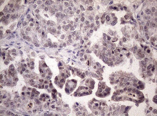 Immunohistochemical staining of paraffin-embedded Adenocarcinoma of Human ovary tissue using anti-LELP1 mouse monoclonal antibody