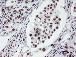 Immunohistochemical staining of paraffin-embedded Carcinoma of Human lung tissue using anti-RNF113B mouse monoclonal antibody