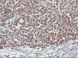 Immunohistochemical staining of paraffin-embedded Adenocarcinoma of Human ovary tissue using anti-RNF113B mouse monoclonal antibody