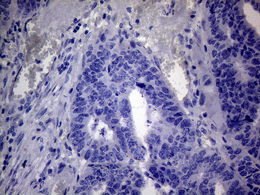 Immunohistochemical staining of paraffin-embedded Adenocarcinoma of Human colon tissue using anti-C4orf36 mouse monoclonal antibody