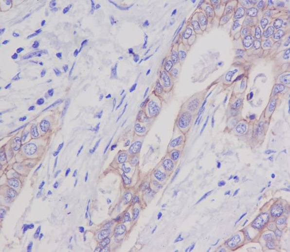 Immunohistochemical analysis of paraffin-embedded human stomach carcinoma, using EpCAM Antibody