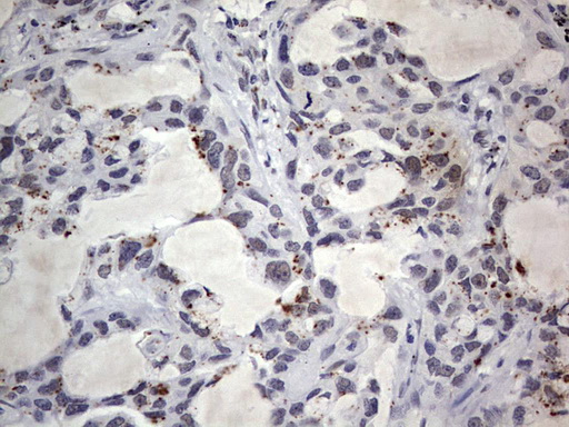 Immunohistochemical staining of paraffin-embedded Carcinoma of Human lung tissue using anti-C14orf166 mouse monoclonal antibody