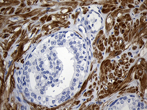 Immunohistochemical staining of paraffin-embedded Carcinoma of Human prostate tissue using anti-C1orf111 mouse monoclonal antibody. (Heat-induced epitope retrieval by 1mM EDTA in 10mM Tris buffer (pH8.5) at 120°C for 3min